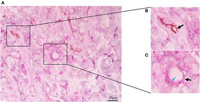 An Overview of Vasculogenic Mimicry in Breast Cancer